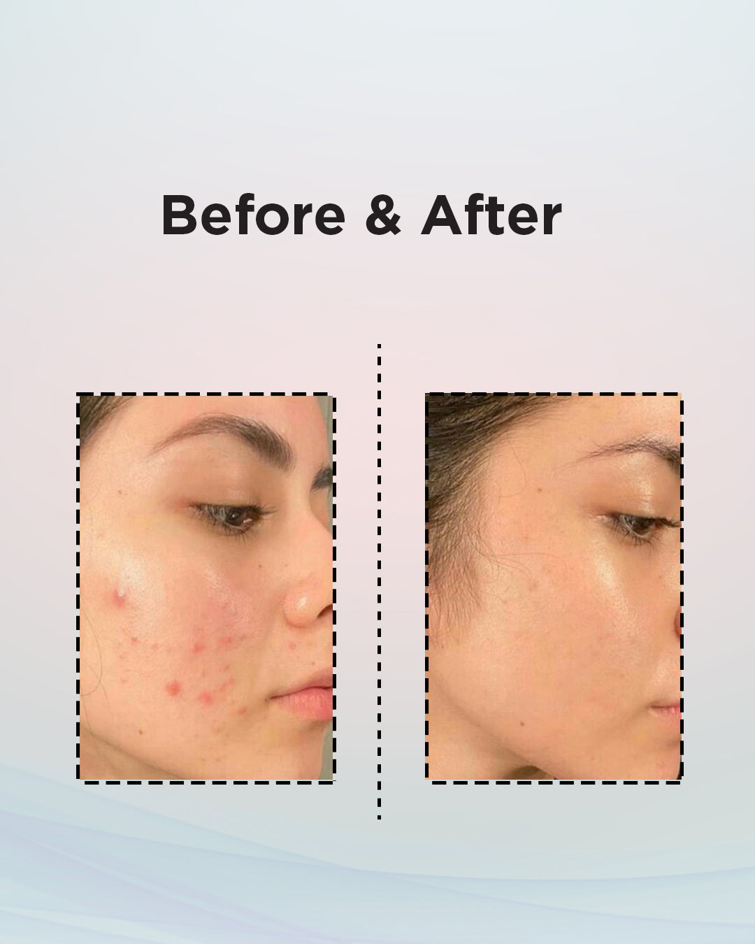 Acne Face Wash & Cream